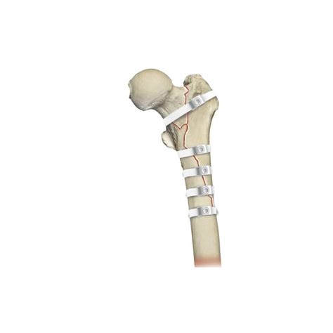 Hip Revision Surgery Bone Cerclage Wiring Ortholox® Uhmwpe Ortolog