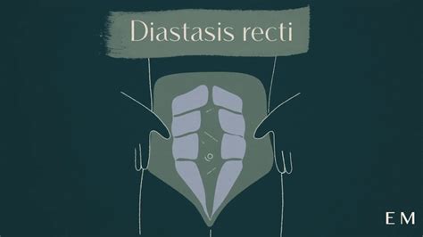 What Is Diastasis Recti Youtube