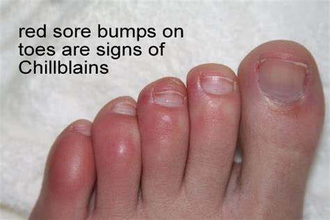 Studies Conclude “covid Toes” Are Unrelated To Covid 19