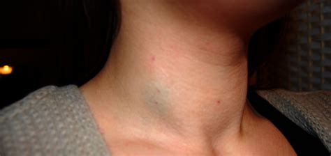 What Does A Swollen Thyroid Look Like Htq