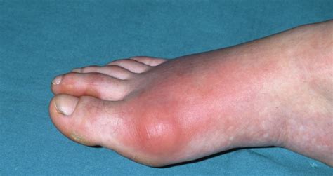 The Most Common Sign Of Gout Is A Nighttime Attack Of Swelling