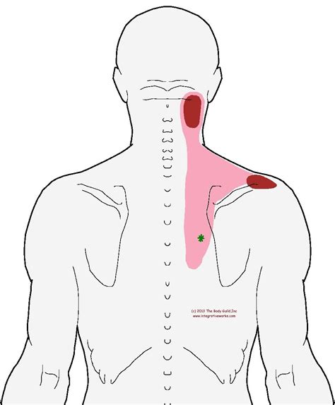 There Are Several Trigger Points Which Create Pain In The Neck Upper