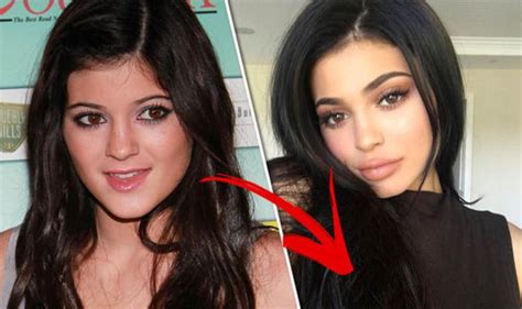 Kylie Jenner Plastic Surgery Before And After Kylie Jenner Plastic