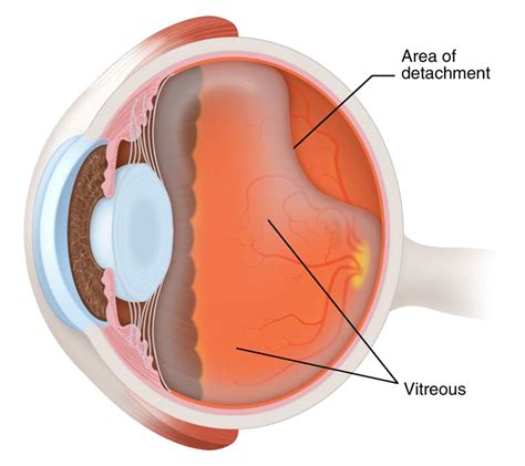 What Is Posterior Vitreous Detachment Jaheed Khan
