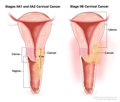 Cervical Cancer Treatment Pdq® Nci