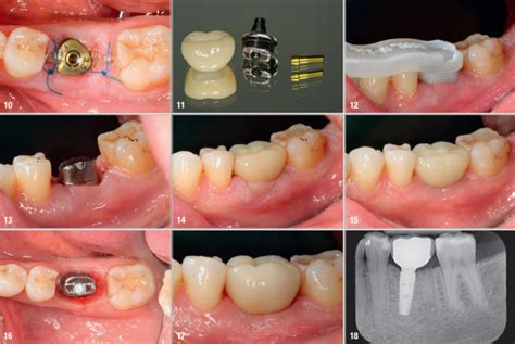 Immediate Implant Placement And Provisionalisation Of A Mandibular