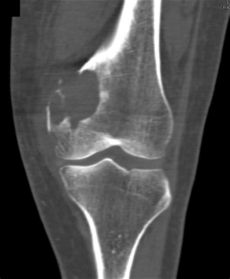 Fractured Aneurysmal Bone Cyst Femur Musculoskeletal Case Studies