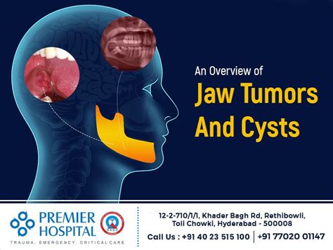 Premier Hospital — An Overview Of Jaw Tumors And Cysts