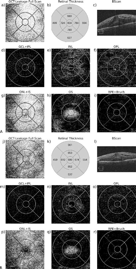 Optical Coherence Tomography Leakage Maps Of A Good Responder Patient