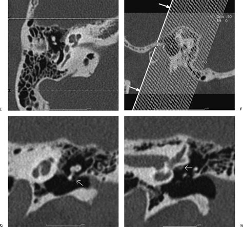 Temporal Bone Imaging Technique Radiology Key