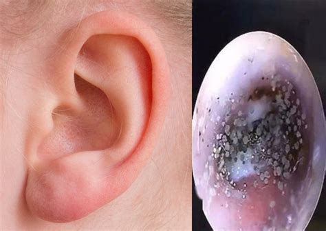 Infected Ear Drum