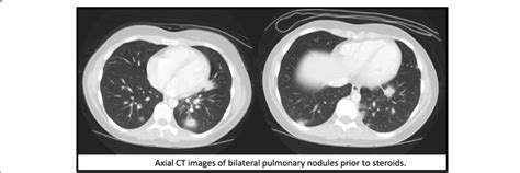 Axial Ct Images Of Bilateral Pulmonary Nodules Prior To Steroids