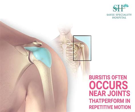 Bursitis Is A Painful Condition That Affects The Small Fluid Filled