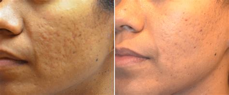 Rf Microneedling For Acne Scars Results On African American Female