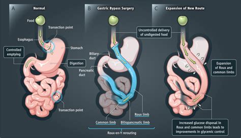 High Quality Best Gastric Bypass Surgery Cost In India