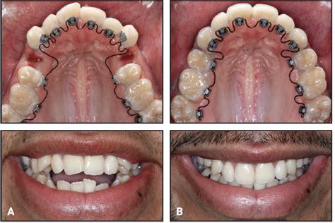 Lingual Orthodontics Redefined With Automation And Friction Free