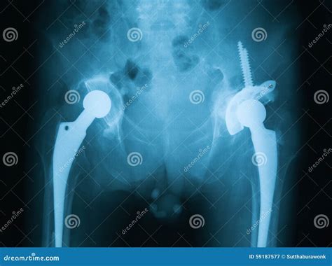 X Ray Image Of Both Hip Showing Hip Replacement Stock Image Image Of