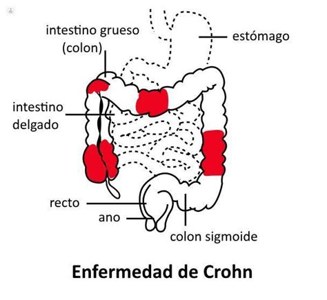 Conoce La Enfermedad De Crohn Coloproct Logo Valencia Top Doctors