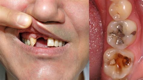 Holes In Teeth That Aren T Cavities Teethwalls