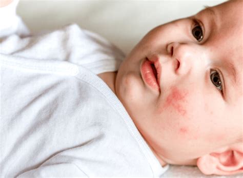 Baby Eczema The Causes Symptoms And Treatments Dr Maraschin