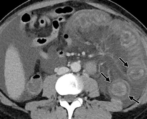 Ct Findings Of Acute Small Bowel Entities Radiographics