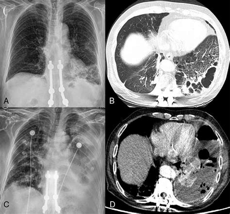 Chest Radiograph And Computed Tomography Ct Images Of Case 1 A And
