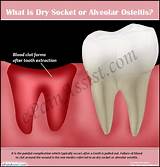 Treatment For Dry Socket After Tooth Removal Images