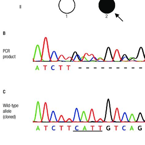Identification Of A Chd7 Mutation In The Patient A Pedigree Of The