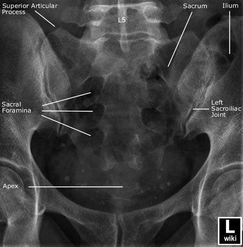 Sacrum Radiographic Anatomy Wikiradiography Diagnostic Imaging