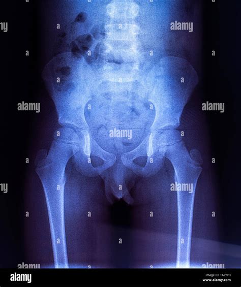 X Ray Of The Pelvic Bones Of The Child Stock Photo Alamy