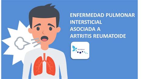 ENFERMEDAD PULMONAR INTERSTICIAL ASOCIADA A ARTRITIS REUMATOIDE Clínica Reumatológica Dr Ponce