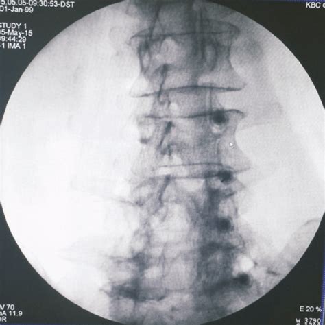 A Oblique Radiograph Of The Lumbar Spine During Lumbar Medial Branch