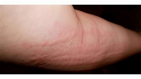 Itching Under Skin No Rash Causes And Treatment Of Pruritus Itchy