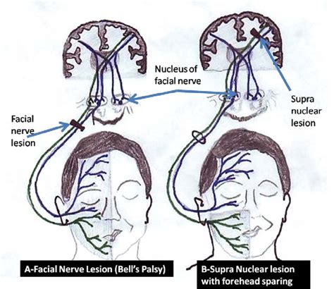 Facial Muscle Paralysis Telegraph