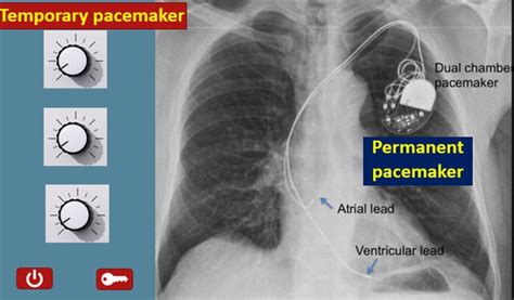 What Is A Pacemaker All About Heart And Blood Vessels