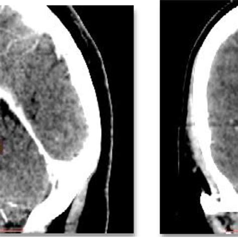 Sagittal And Coronal Contrast Enhanced Ct Images Showing Download