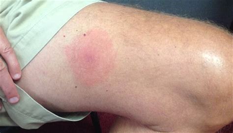 Clinical Challenge Is This Rash Lyme Disease Mpr