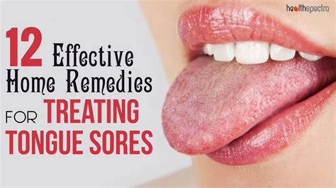 12 Effective Remedies For Treating Tongue Sores Healthspectra Youtube