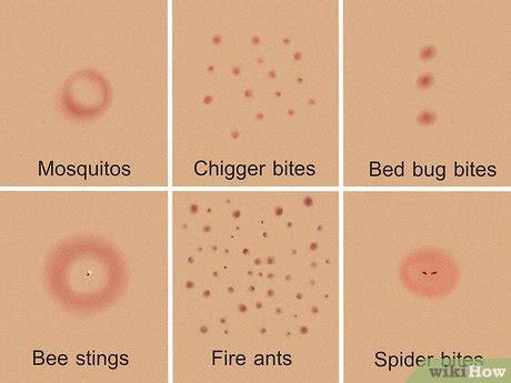 How To Identify Insect Bites Bug Bites Stings