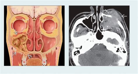 Squamous Cell Carcinoma Nasal Cavity