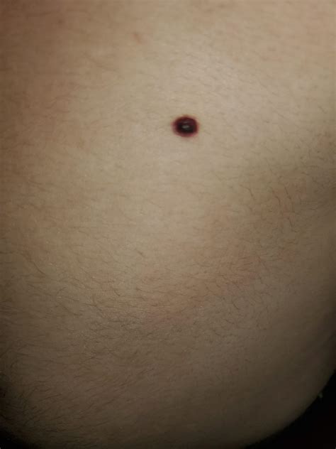 Mole Used To Brown And Flat And The Redness Around Seems To Be Moving