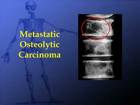 Ppt Metastatic Bone Disease And Multiple Myeloma Powerpoint