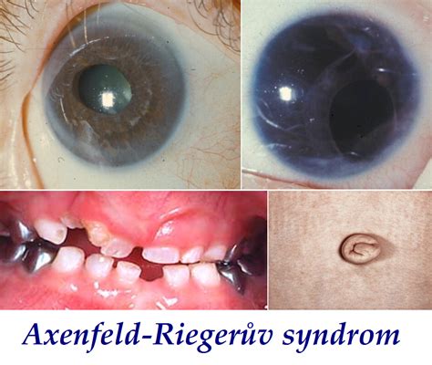 Axenfeld Riegerův Syndrom Příznaky Projevy Symptomy Příčina Léčba