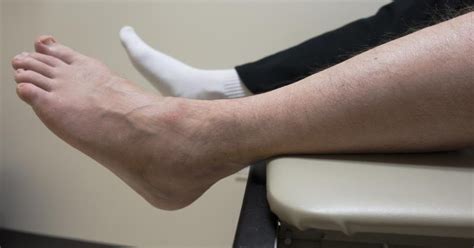 Causes Of A Swollen Ankle With No Pain Livestrongcom