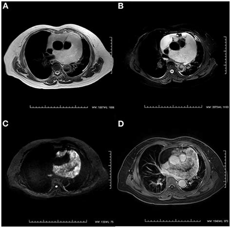 Frontiers Multimodal Diagnostic Workup Of Primary Pericardial