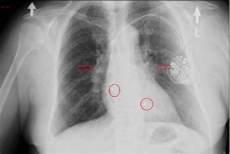 Chest X Ray Image Show Bihilar Lymph Nodes Enlargement Red Arrows And