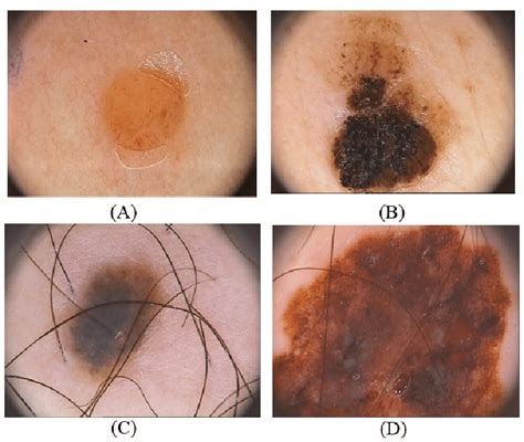 Different Types Of Dermoscopy Images For Both Type Benign And Melanoma