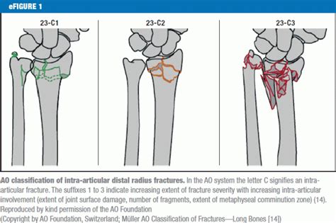 Intra Articular Distal Radius Fracture