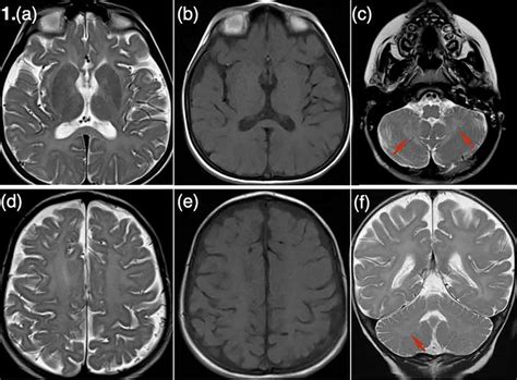 Brain Mri Findings Of The Patients A T2 Weighted Axial Image Of The