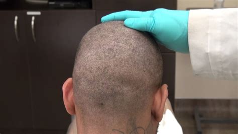 Fue Hair Transplant Donor Scar Demonstration By Drdiep